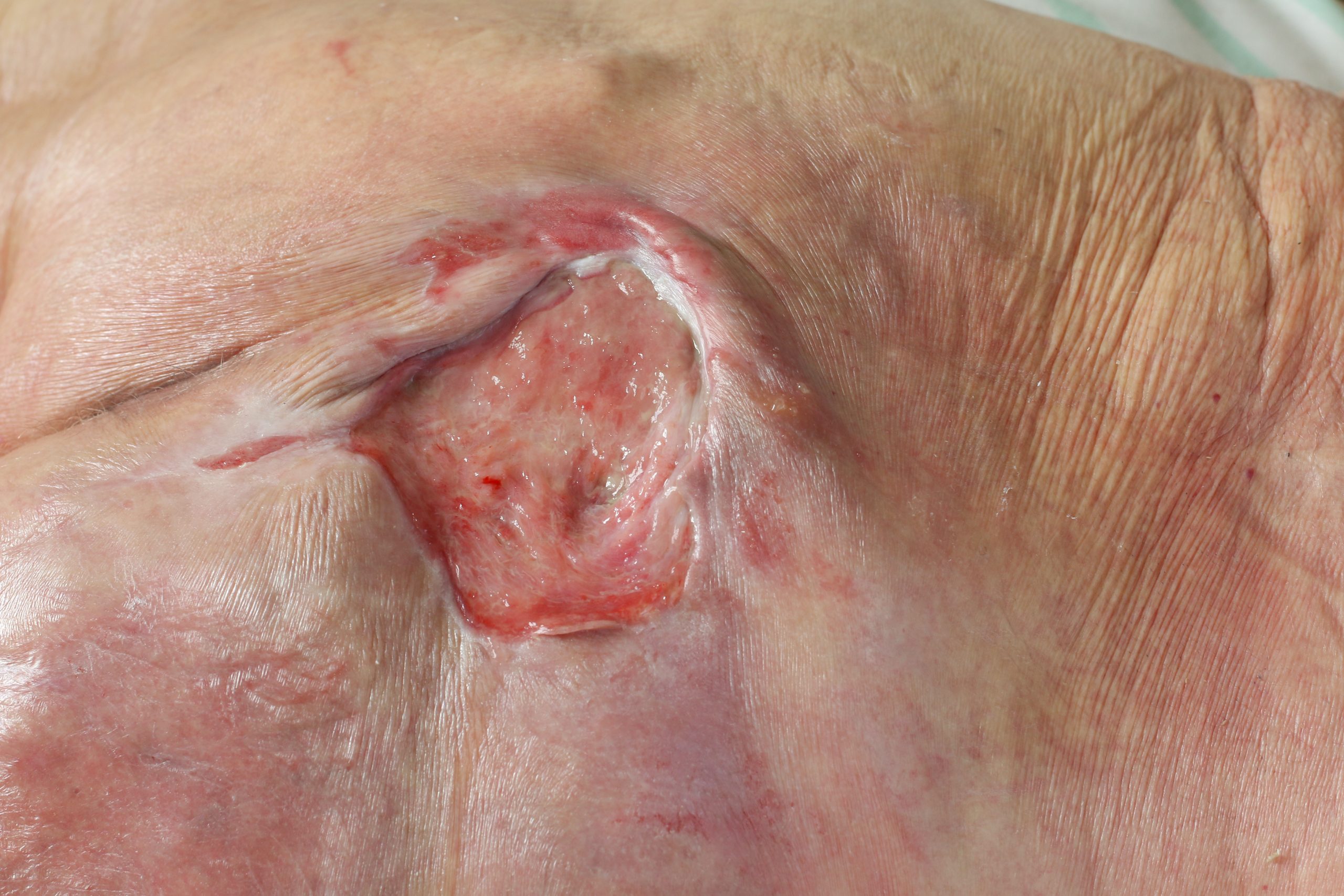 Skin & Pressure Sores after Spinal Cord Injury