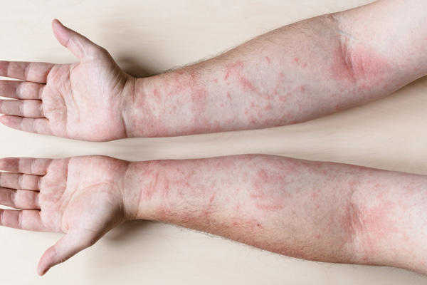 Arms with contact dermatitis rash
