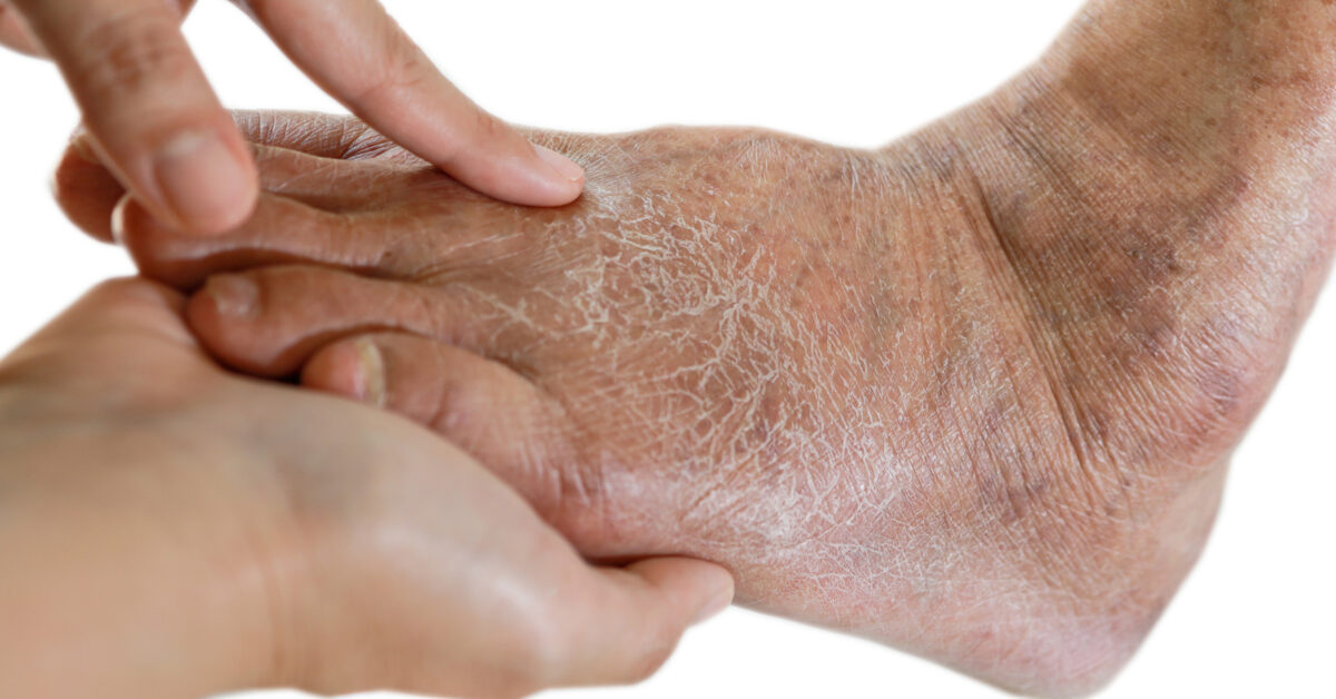 Tissue Paper Skin AMERIGEL Advanced Skin & Wound Care