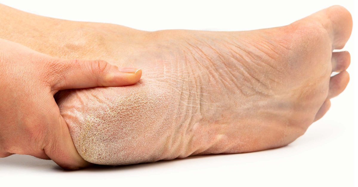 Tinea Pedis AMERIGEL Advanced Skin & Wound Care